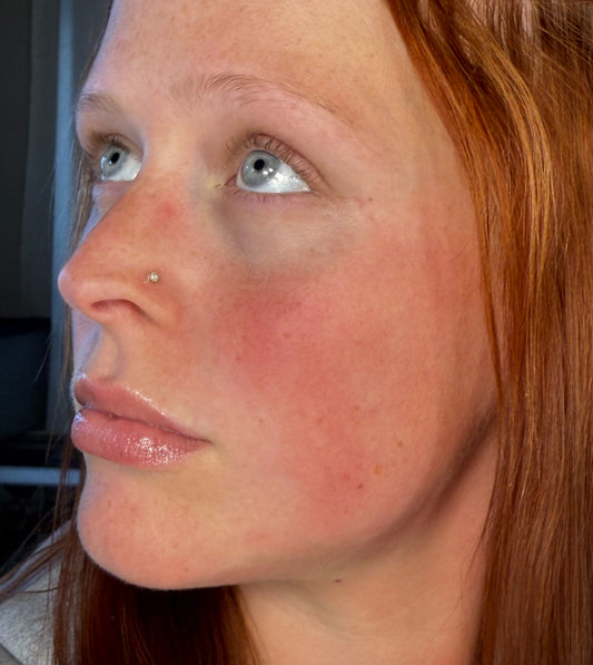 Featured image for the article Facial Redness: Causes, Triggers, and How to Calm It